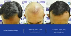 dr ruz hair transplant slider photo 27