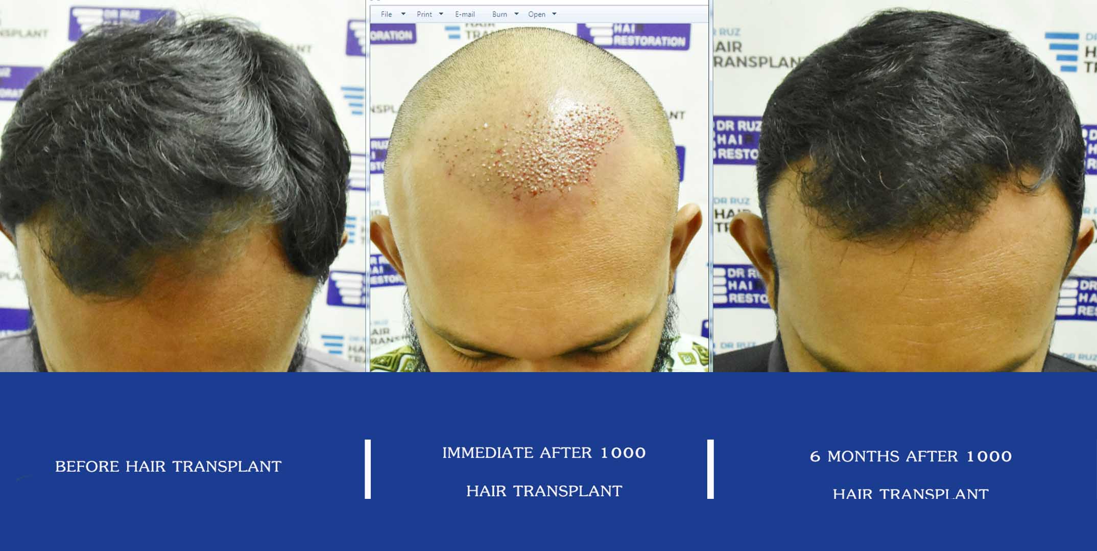 dr ruz hair transplant slider photo 27