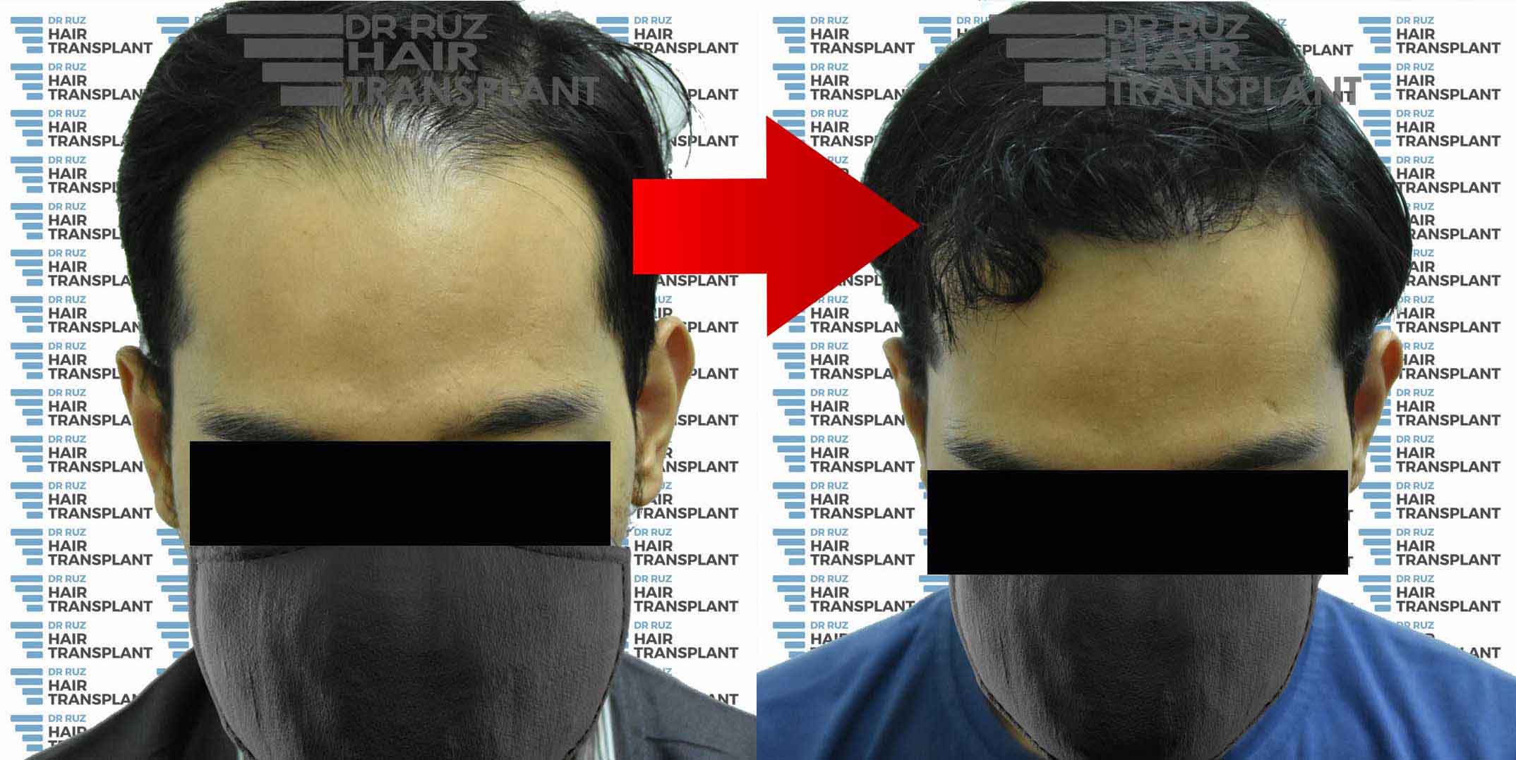 dr ruz hair transplant slider photo 28