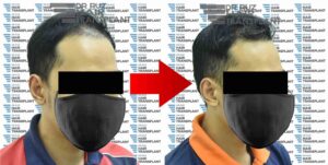 dr ruz hair transplant slider photo 29