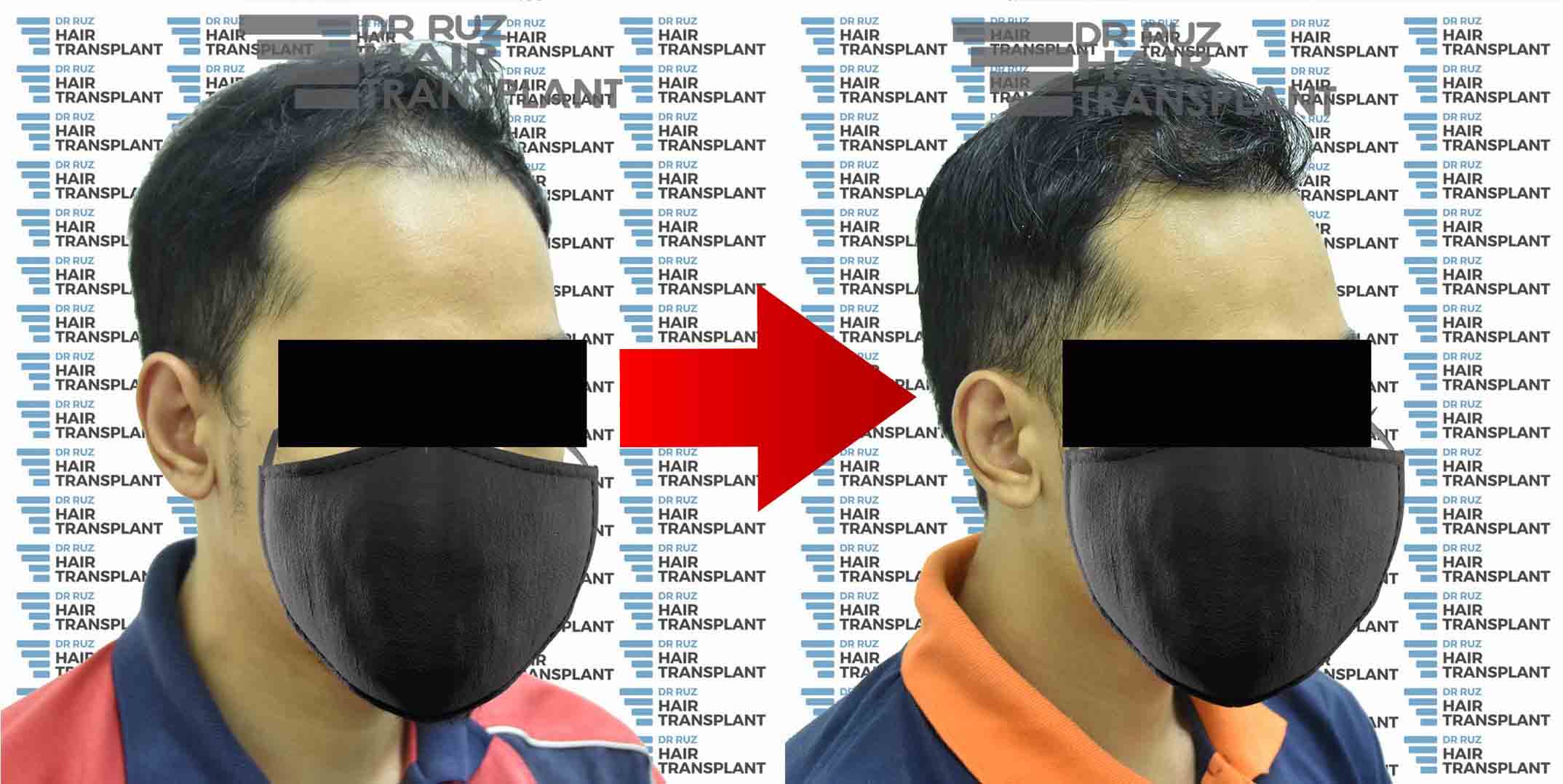 dr ruz hair transplant slider photo 29