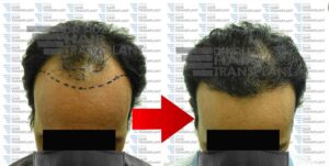 dr ruz hair transplant slider photo 30dr ruz hair transplant slider photo 30