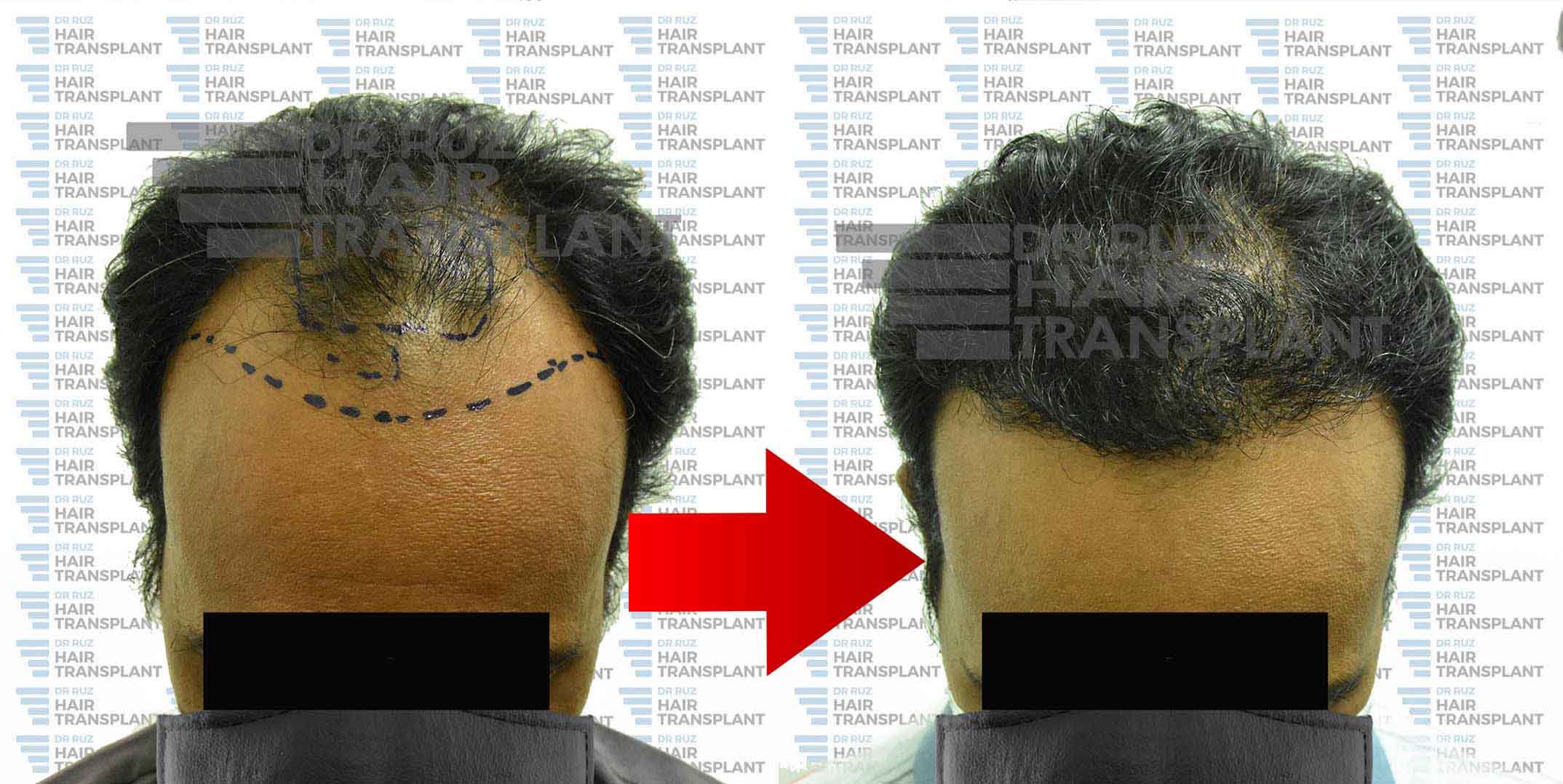 dr ruz hair transplant slider photo 30dr ruz hair transplant slider photo 30
