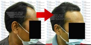 dr ruz hair transplant slider photo 31