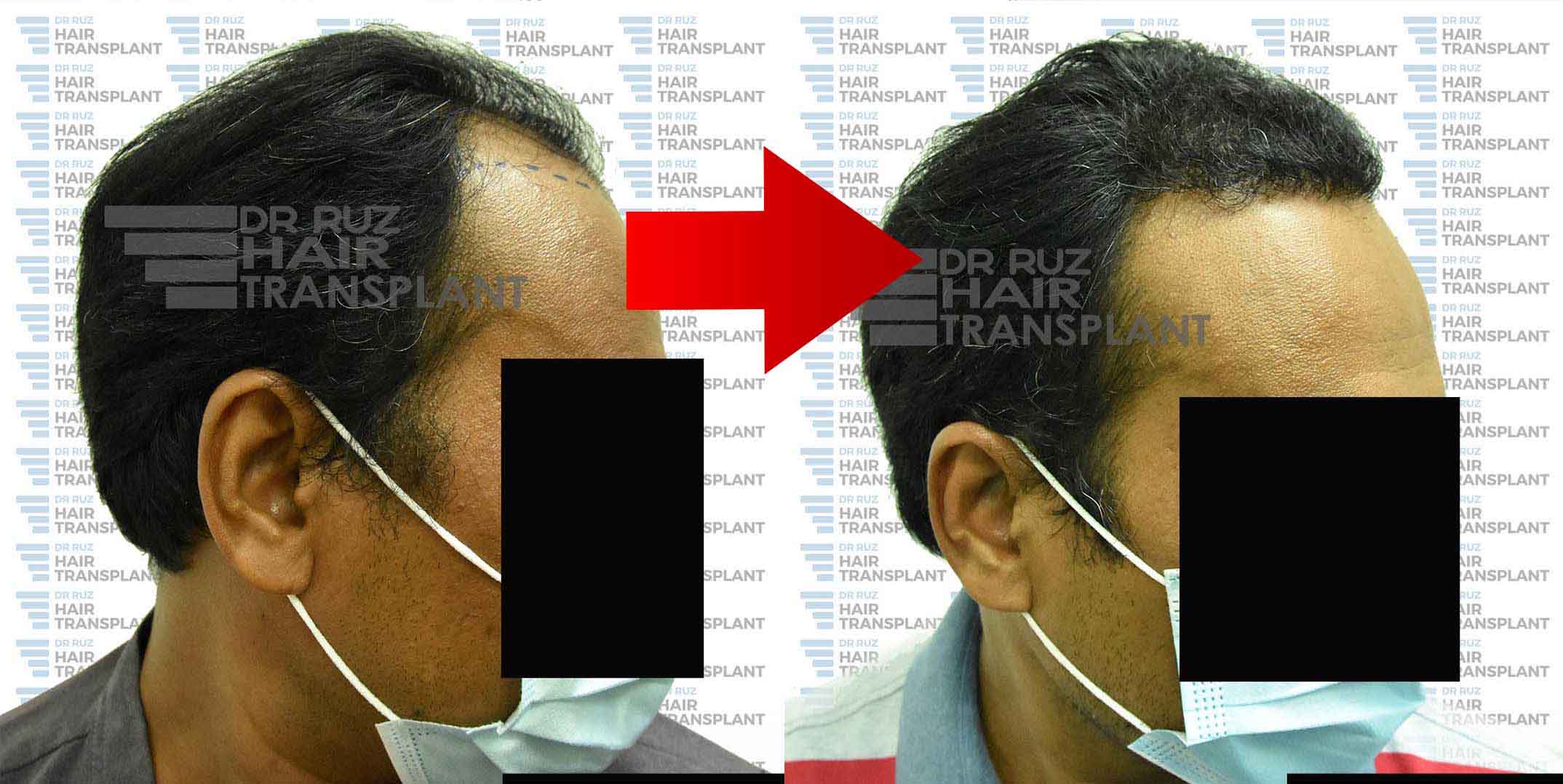 dr ruz hair transplant slider photo 31