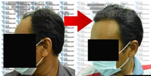 dr ruz hair transplant slider photo 32