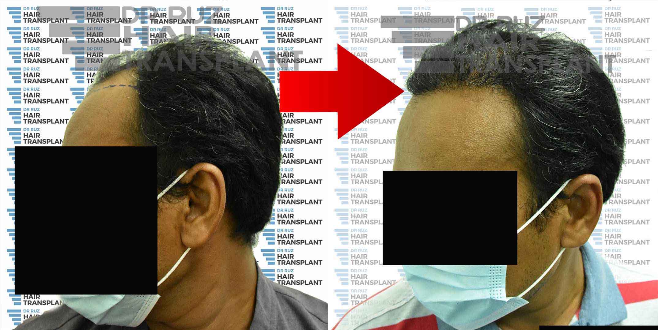 dr ruz hair transplant slider photo 32