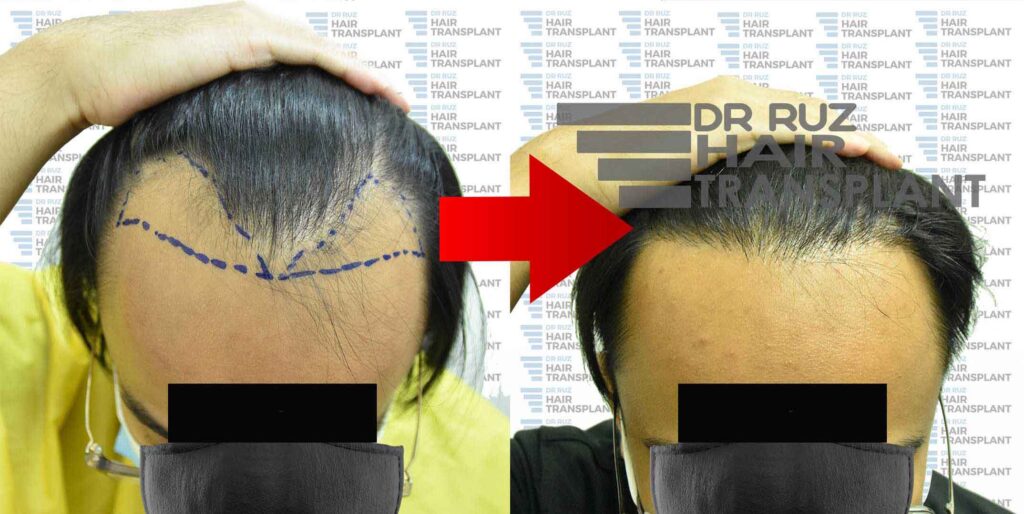 dr ruz hair transplant slider photo 33
