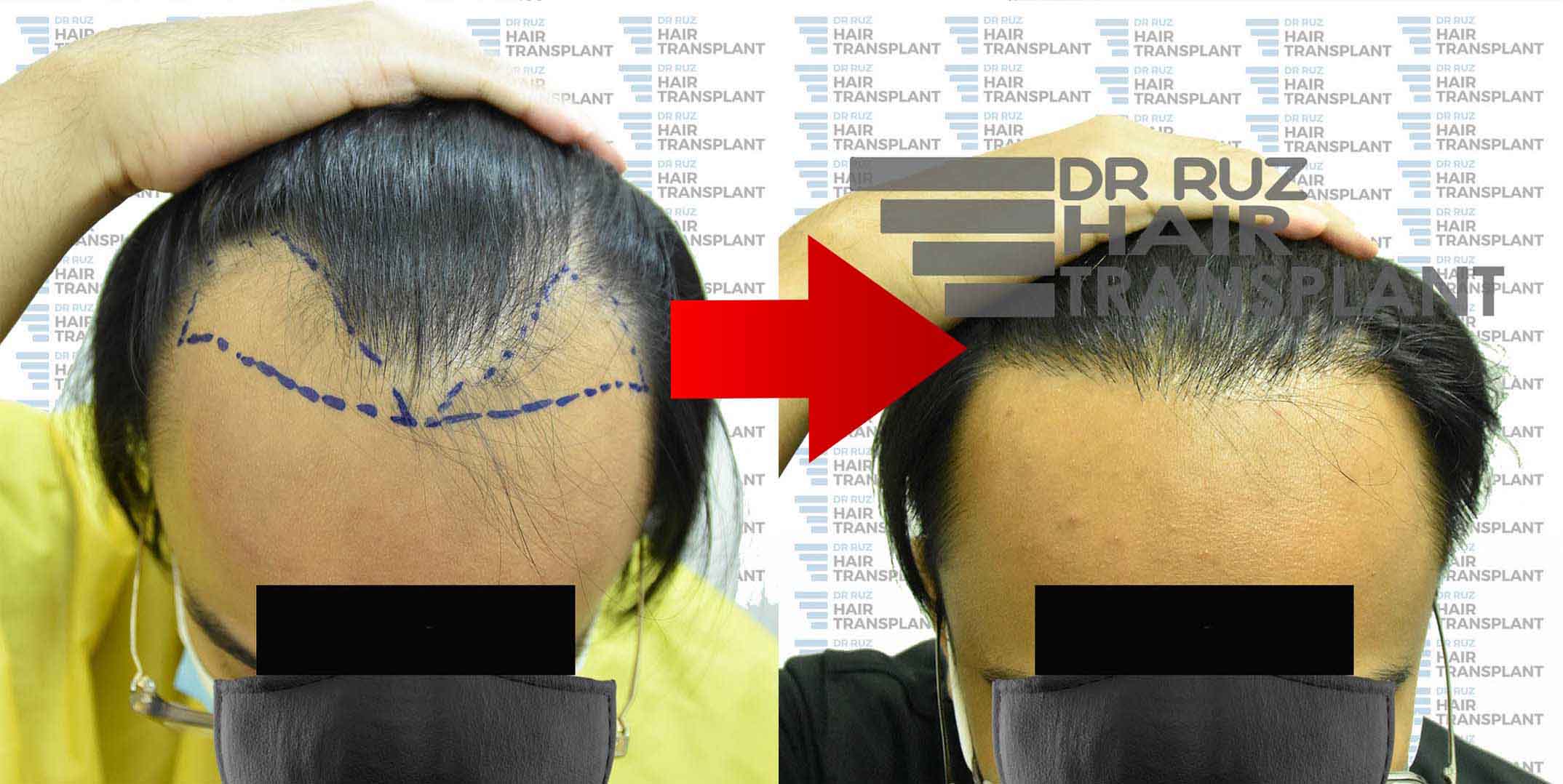 dr ruz hair transplant slider photo 33