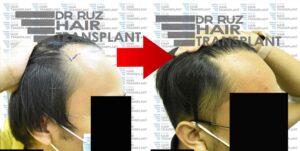 dr ruz hair transplant slider photo 34