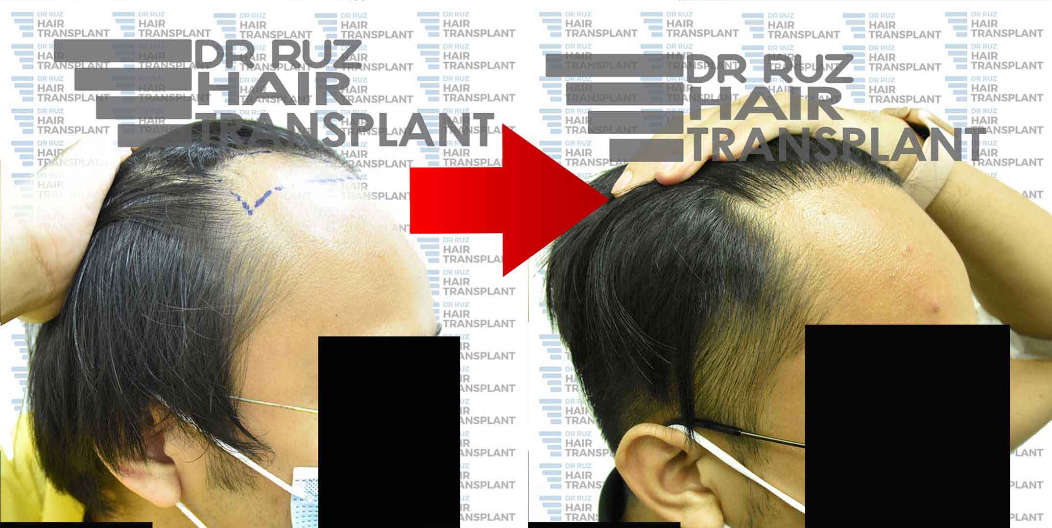 dr ruz hair transplant slider photo 34