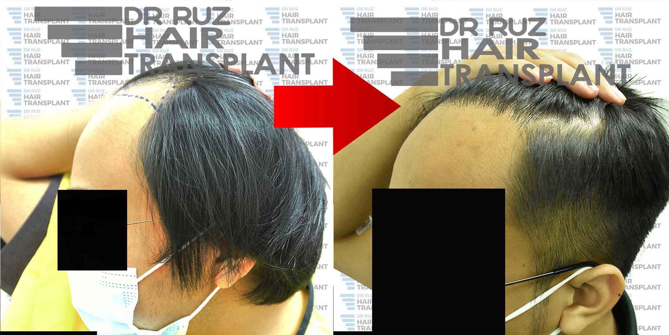 dr ruz hair transplant slider photo 35