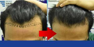 Before and after hair transplant results by Dr. Ruz showing natural hairline restoration and increased density.