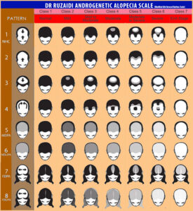 Dr. Ruz’s customized Androgenetic Alopecia Scale showing different stages and patterns of hair loss in men and women.