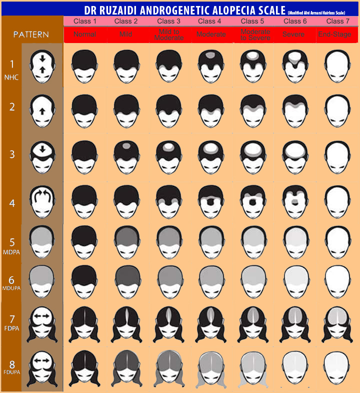 Dr. Ruz’s customized Androgenetic Alopecia Scale showing different stages and patterns of hair loss in men and women.