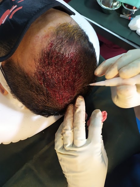 dr ruz hair transplant pf