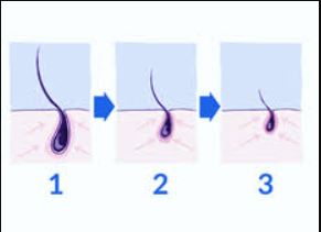 Graphic showing hair miniaturization process in male pattern baldness (androgenetic alopecia)