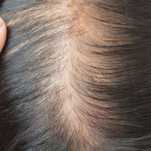 Close-up image showing early signs of hair thinning, a common indicator of progressive hair loss