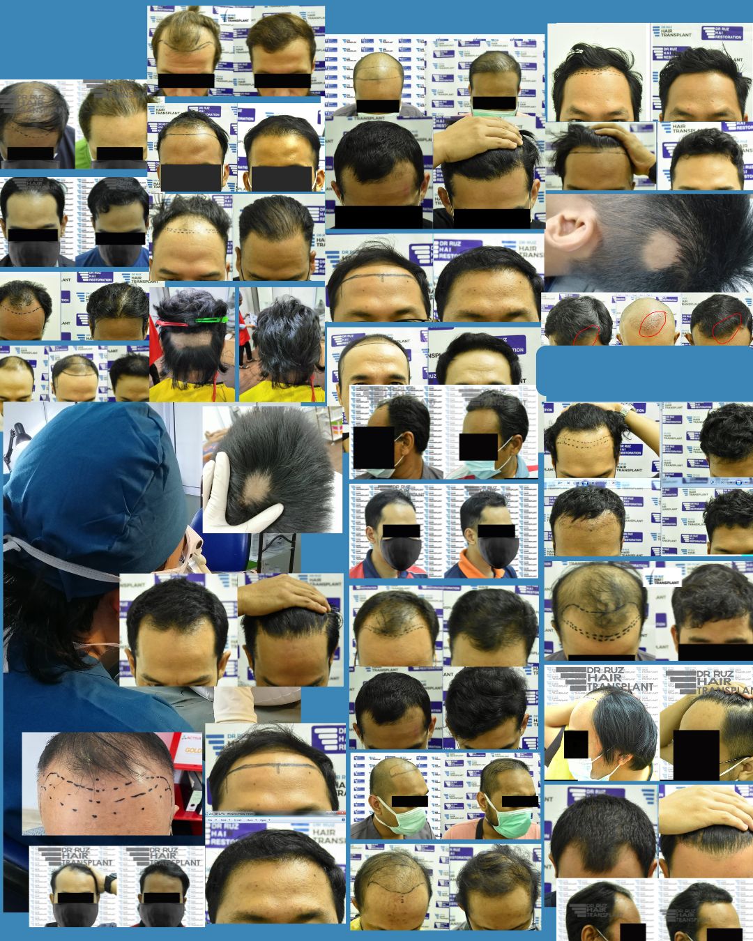 Collage of Dr. Ruz's international hair transplant patients, including before-and-after results from Malaysia