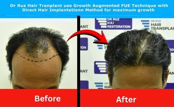 Before and after hair transplant by Dr. Ruz showing restored hairline and youthful appearance