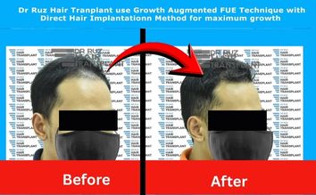 Patient before and after Dr. Ruz hair transplant showing restored hairline and youthful look