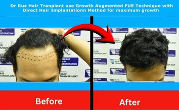 Before and after hair transplant by Dr. Ruz showing thick, natural hairline restoration