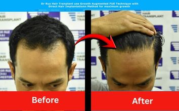 Patient before and after Dr. Ruz hair transplant showing fuller hairline and restored confidence