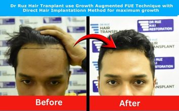 Before and after hair transplant by Dr. Ruz showing restored hairline and youthful appearance