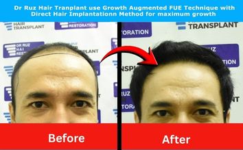 Before and after Dr. Ruz hair transplant showing natural, full hairline and confidence boost