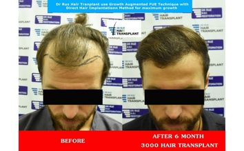 Before and after hair transplant by Dr. Ruz showing natural hairline restoration and increased confidence