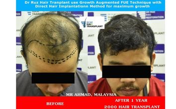 Patient’s hair transformation with Dr. Ruz showing full, natural hairline after FUE transplant
