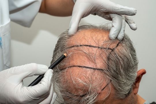 Hair restoration procedure customized for a patient’s facial structure, hair pattern, and natural aging.