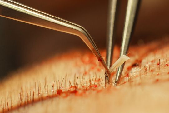 Private hair restoration procedure designed for patient confidentiality and comfort.
