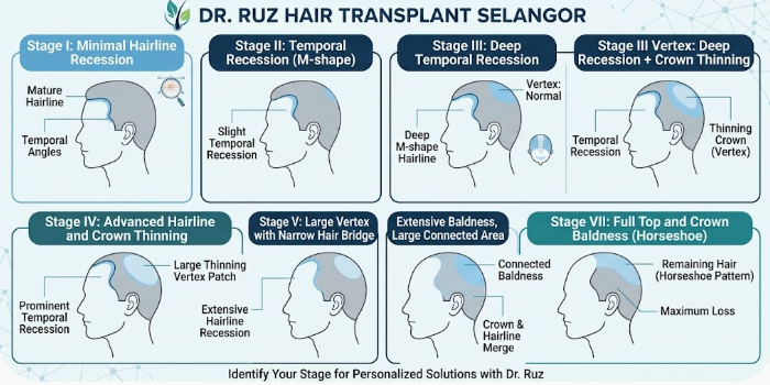Norwood scale chart showing hair loss stages from Stage 1 to Stage 7 for hair transplant Malaysia evaluation at Dr. Ruz Hair Transplant Malaysia.